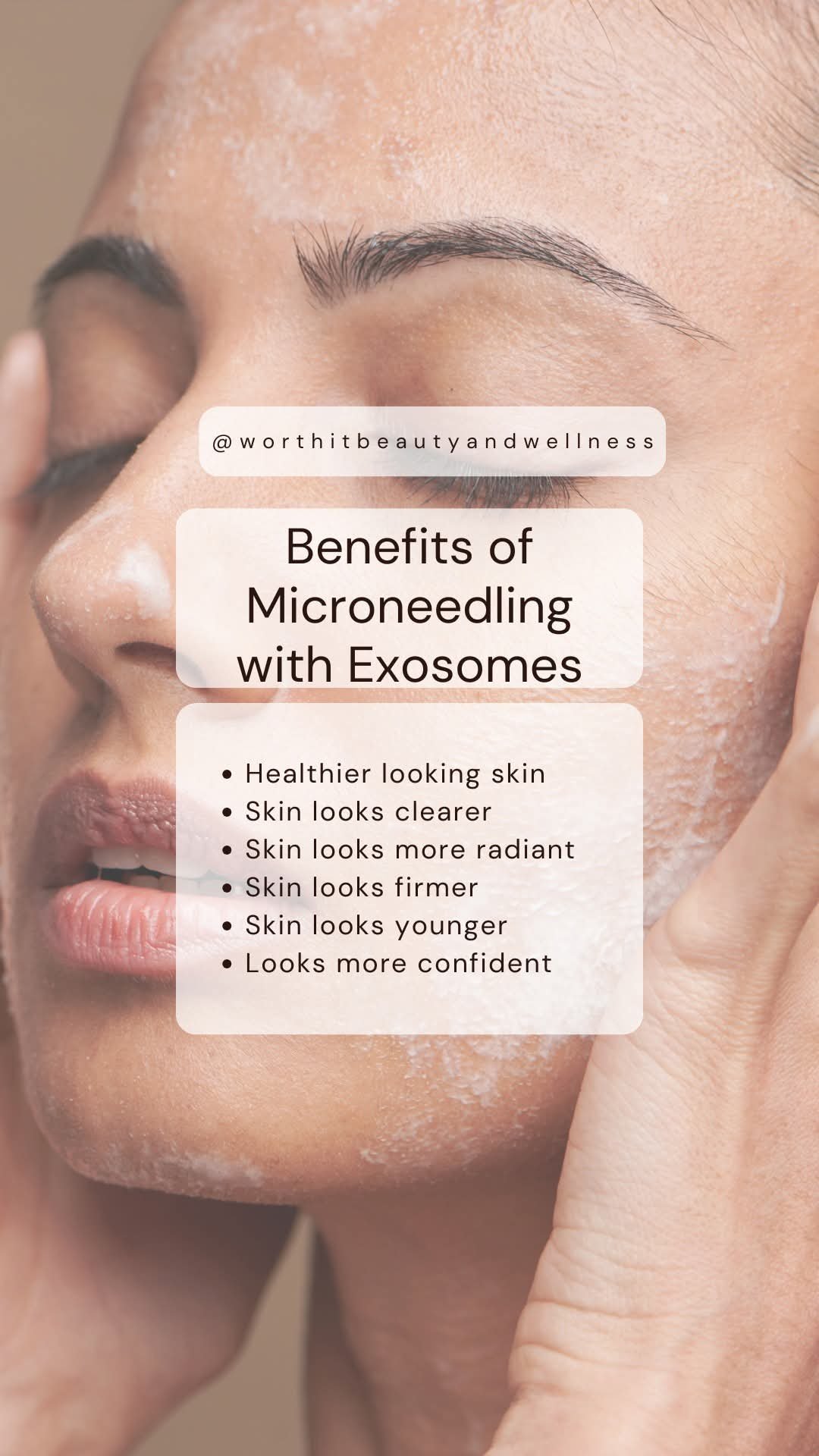 Real RF microneedling treatment in progress